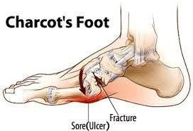 Charcot Foot,